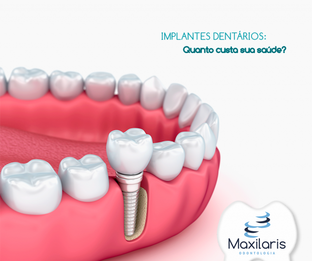 Implantes Dentários: quanto custa sua saúde? por Dr. Renato Jordão