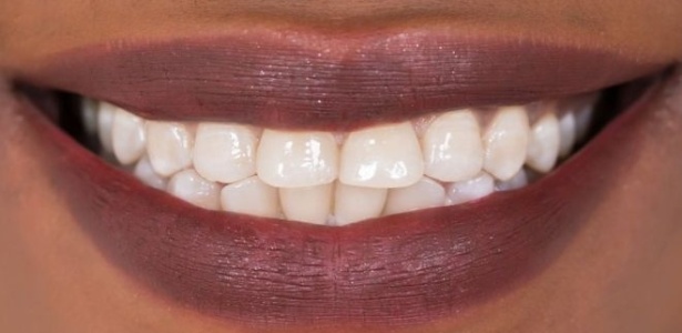 Cientistas britânicos criam substância que pode regenerar dentes